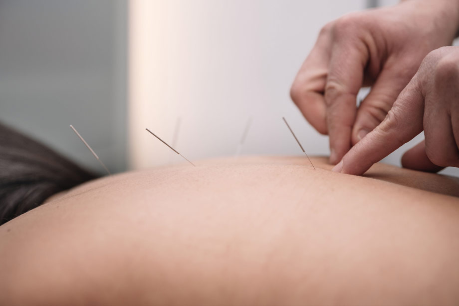 Τοποθέτηση βελόνων στην πλάτη για φυσική υποστήριξη σε αυτοάνοσα νοσήματα μέσω βελονισμού